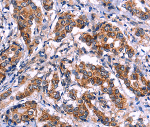 Immunohistochemistry of paraffin-embedded Human breast cancer tissue using EIF2AK4 Polyclonal Antibody at dilution 1:50