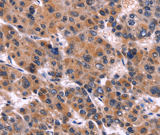 Immunohistochemistry of paraffin-embedded Human liver cancer tissue using EIF2AK4 Polyclonal Antibody at dilution 1:50