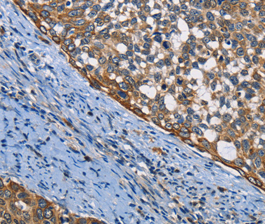 Immunohistochemistry of paraffin-embedded Human cervical cancer using PGK1 Polyclonal Antibody at dilution of 1:50