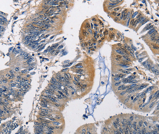 Immunohistochemistry of paraffin-embedded Human colon cancer using PGK1 Polyclonal Antibody at dilution of 1:50