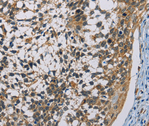 Immunohistochemistry of paraffin-embedded Human cervical cancer using CSNK1E Polyclonal Antibody at dilution of 1:60