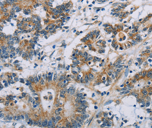 Immunohistochemistry of paraffin-embedded Human colon cancer using CSNK1E Polyclonal Antibody at dilution of 1:60