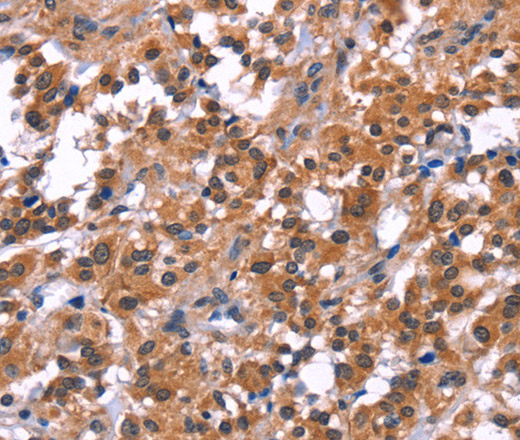 Immunohistochemistry of paraffin-embedded Human thyroid cancer tissue using PIP5K1B Polyclonal Antibody at dilution 1:30