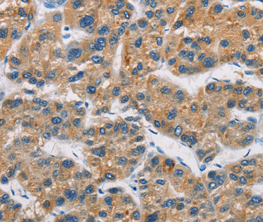 Immunohistochemistry of paraffin-embedded Human liver cancer tissue using CERK Polyclonal Antibody at dilution 1:30