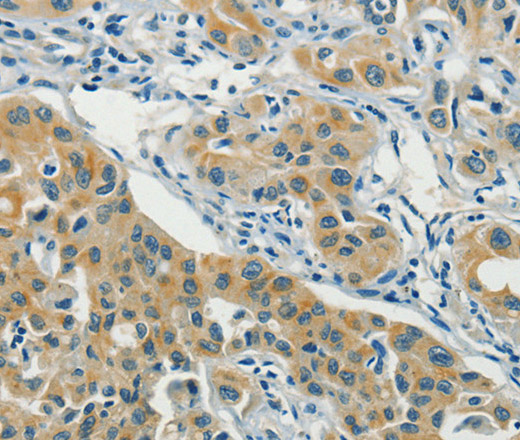 Immunohistochemistry of paraffin-embedded Human lung cancer using ASAH2 Polyclonal Antibody at dilution of 1:40