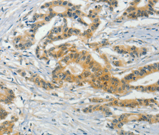 Immunohistochemistry of paraffin-embedded Human colon cancer tissue using ASB8 Polyclonal Antibody at dilution 1:50