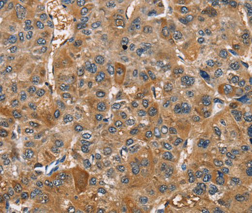 Immunohistochemistry of paraffin-embedded Human liver cancer tissue using TRIP4 Polyclonal Antibody at dilution 1:40