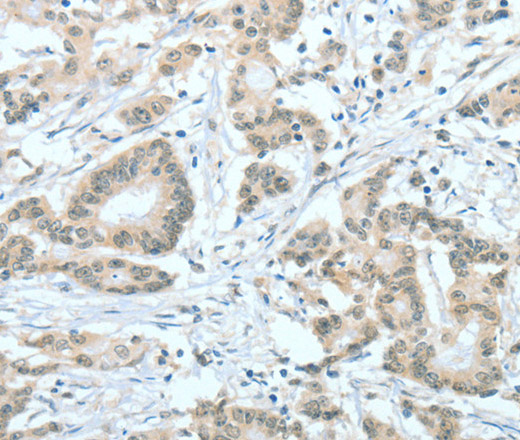 Immunohistochemistry of paraffin-embedded Human colon cancer tissue using ASH2L Polyclonal Antibody at dilution 1:60