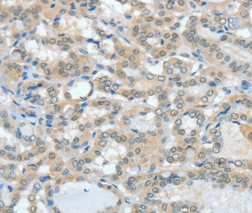 Immunohistochemistry of paraffin-embedded Human thyroid cancer tissue using ASH2L Polyclonal Antibody at dilution 1:60