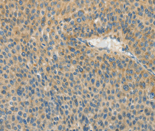 Immunohistochemistry of paraffin-embedded Human liver cancer using ASPA Polyclonal Antibody at dilution of 1:80