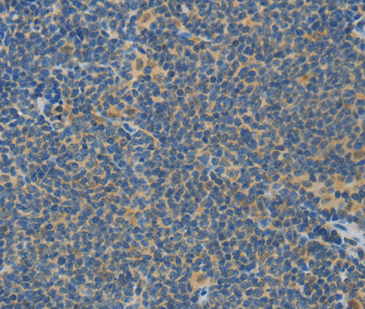 Immunohistochemistry of paraffin-embedded Human lymphoma using ASPA Polyclonal Antibody at dilution of 1:80