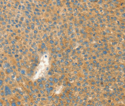 Immunohistochemistry of paraffin-embedded Human liver cancer tissue using AANAT Polyclonal Antibody at dilution 1:40