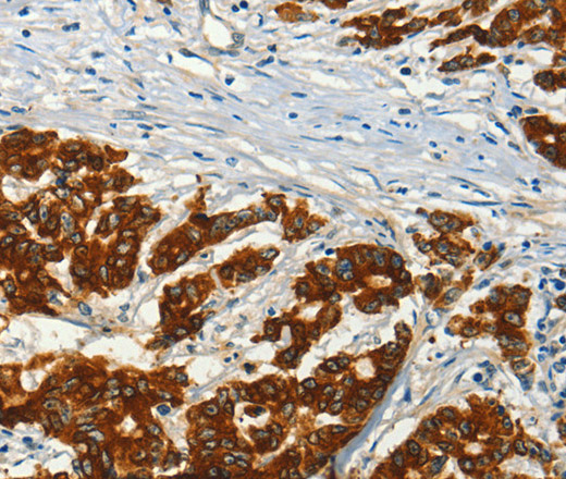 Immunohistochemistry of paraffin-embedded Human colon cancer using ADCY3 Polyclonal Antibody at dilution of 1:50