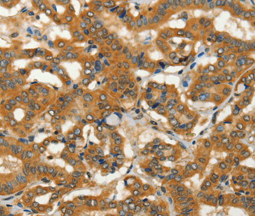 Immunohistochemistry of paraffin-embedded Human thyroid cancer using ADCY3 Polyclonal Antibody at dilution of 1:50