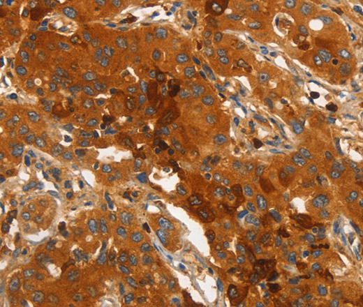 Immunohistochemistry of paraffin-embedded Human lung cancer using ORM2 Polyclonal Antibody at dilution of 1:40