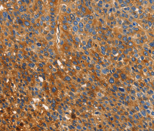 Immunohistochemistry of paraffin-embedded Human liver cancer using ORM2 Polyclonal Antibody at dilution of 1:40