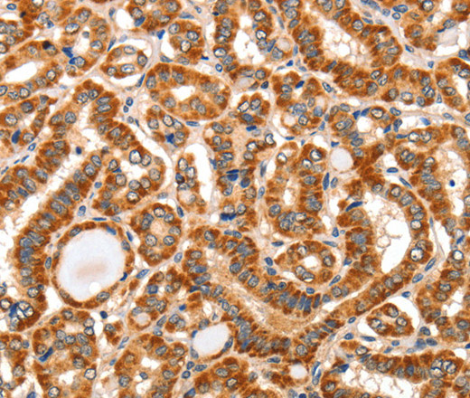 Immunohistochemistry of paraffin-embedded Human thyroid cancer tissue using AIM2 Polyclonal Antibody at dilution 1:60