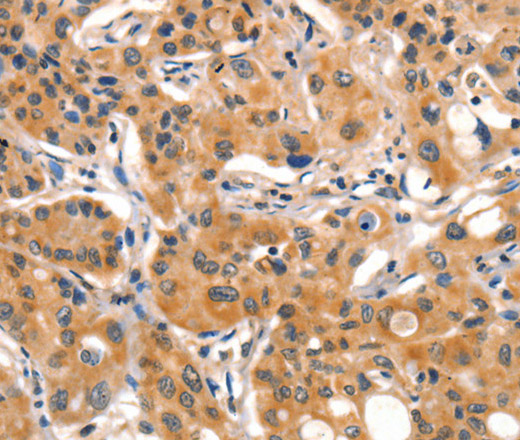 Immunohistochemistry of paraffin-embedded Human lung cancer tissue using AIM2 Polyclonal Antibody at dilution 1:60