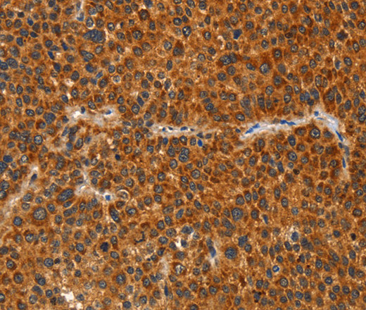 Immunohistochemistry of paraffin-embedded Human liver cancer tissue using IKZF3 Polyclonal Antibody at dilution 1:60