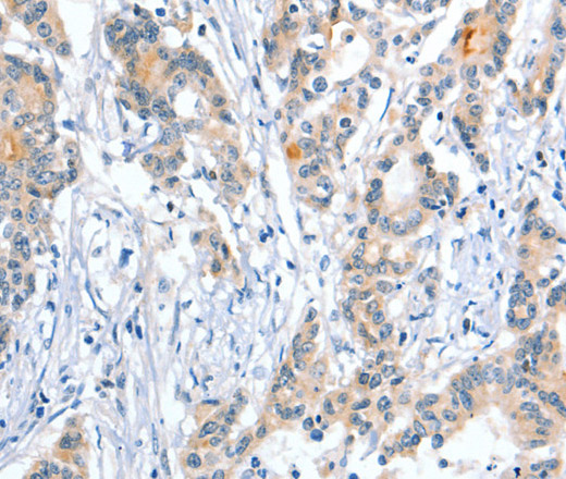 Immunohistochemistry of paraffin-embedded Human colon cancer using Placental Alkaline Phosphatase Polyclonal Antibody at dilution of 1:50