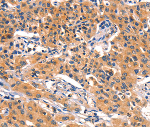 Immunohistochemistry of paraffin-embedded Human lung cancer using AMY2A Polyclonal Antibody at dilution of 1:50