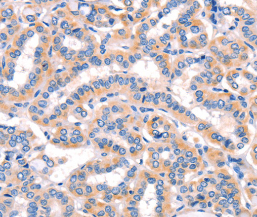 Immunohistochemistry of paraffin-embedded Human thyroid cancer using AMY2A Polyclonal Antibody at dilution of 1:50