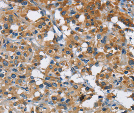 Immunohistochemistry of paraffin-embedded Human thyroid cancer tissue using ANKHD1 Polyclonal Antibody at dilution 1:40