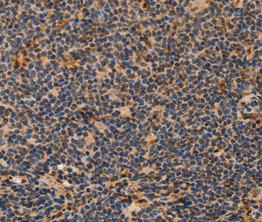 Immunohistochemistry of paraffin-embedded Human Lymphoma using MPG Polyclonal Antibody at dilution of 1:40