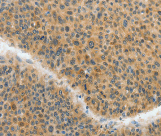 Immunohistochemistry of paraffin-embedded Human liver cancer tissue using ACLY Polyclonal Antibody at dilution 1:40