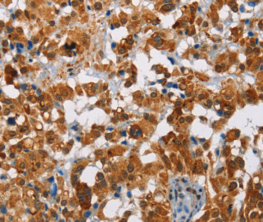 Immunohistochemistry of paraffin-embedded Human thyroid cancer tissue using ATXN1 Polyclonal Antibody at dilution 1:40