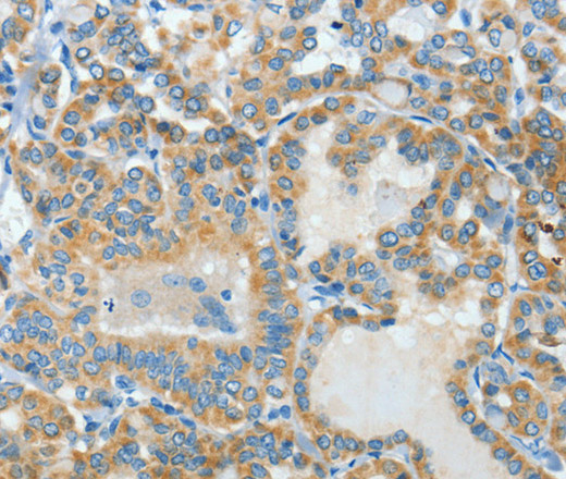 Immunohistochemistry of paraffin-embedded Human thyroid cancer using BAAT Polyclonal Antibody at dilution of 1:30