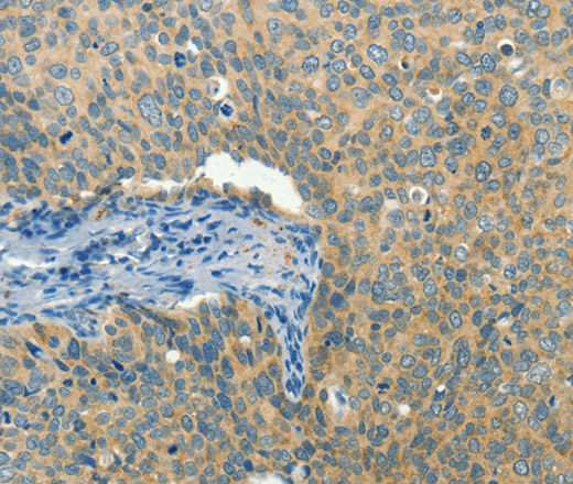 Immunohistochemistry of paraffin-embedded Human cervical cancer tissue using BCAT1 Polyclonal Antibody at dilution 1:50