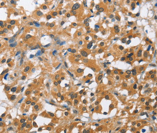 Immunohistochemistry of paraffin-embedded Human thyroid cancer using BCL10 Polyclonal Antibody at dilution of 1:40