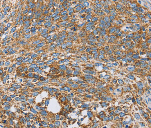 Immunohistochemistry of paraffin-embedded Human cervical cancer tissue using CENPO Polyclonal Antibody at dilution 1:40