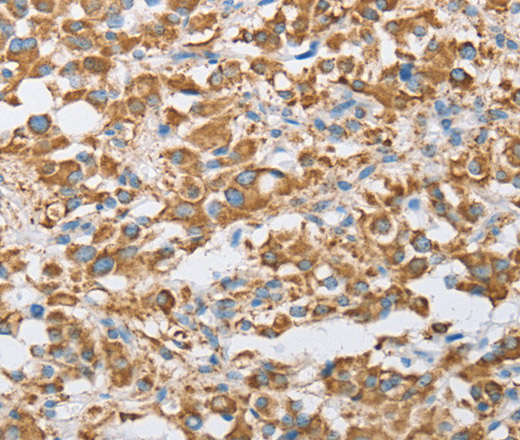 Immunohistochemistry of paraffin-embedded Human thyroid cancer tissue using CENPO Polyclonal Antibody at dilution 1:40