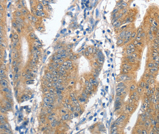 Immunohistochemistry of paraffin-embedded Human colon cancer tissue using CENPC Polyclonal Antibody at dilution 1:70