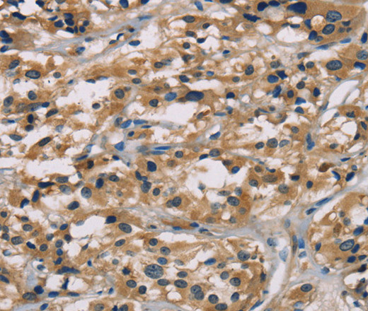 Immunohistochemistry of paraffin-embedded Human thyroid cancer tissue using hCG Polyclonal Antibody at dilution 1:65