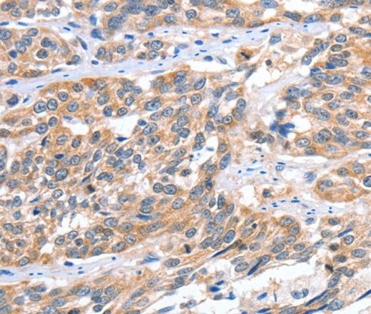 Immunohistochemistry of paraffin-embedded Human esophagus cancer tissue using CGB Polyclonal Antibody at dilution 1:60