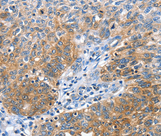 Immunohistochemistry of paraffin-embedded Human ovarian cancer tissue using CGB Polyclonal Antibody at dilution 1:60