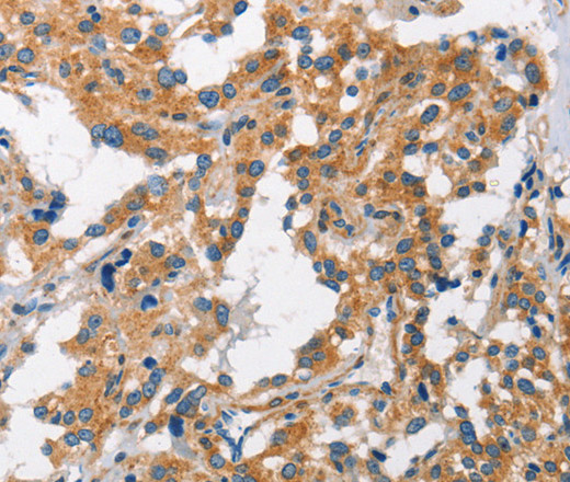 Immunohistochemistry of paraffin-embedded Human thyroid cancer tissue using CHMP1A Polyclonal Antibody at dilution 1:60