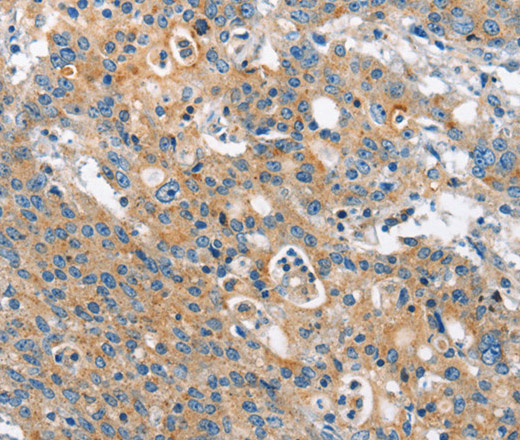 Immunohistochemistry of paraffin-embedded Human gastric cancer tissue using CHMP1A Polyclonal Antibody at dilution 1:60