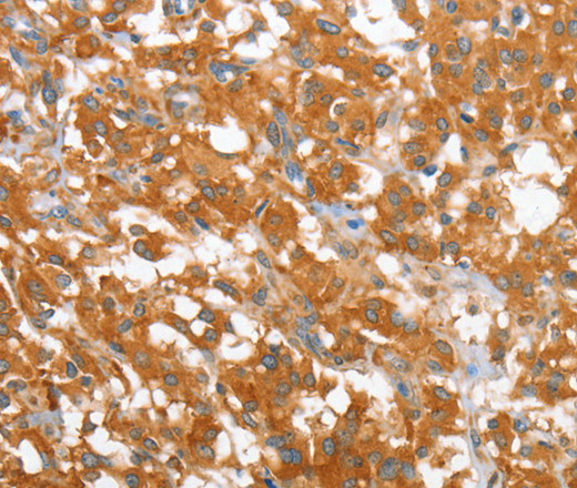 Immunohistochemistry of paraffin-embedded Human thyroid cancer using WNT3A Polyclonal Antibody at dilution of 1:40