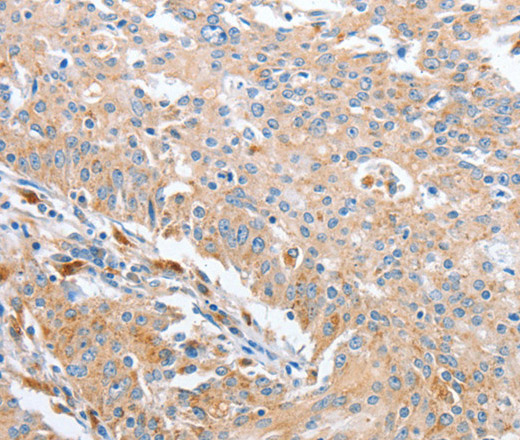 Immunohistochemistry of paraffin-embedded Human gastric cancer using WNT3A Polyclonal Antibody at dilution of 1:40