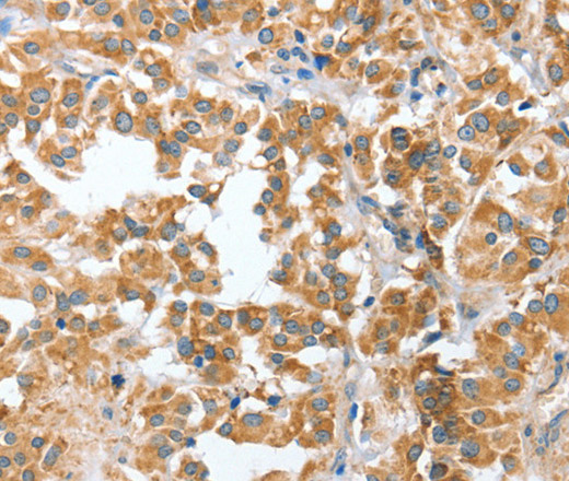 Immunohistochemistry of paraffin-embedded Human thyroid cancer tissue using CIAPIN1 Polyclonal Antibody at dilution 1:60