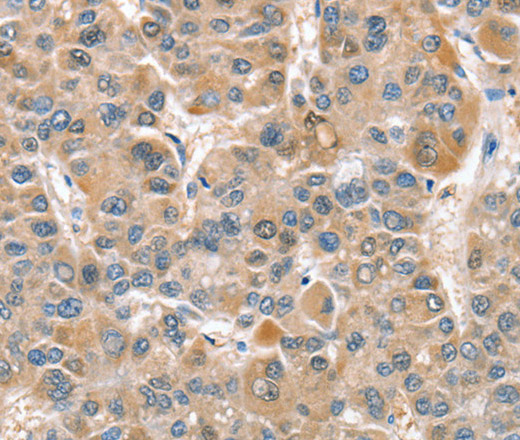 Immunohistochemistry of paraffin-embedded Human liver cancer tissue using CIAPIN1 Polyclonal Antibody at dilution 1:60