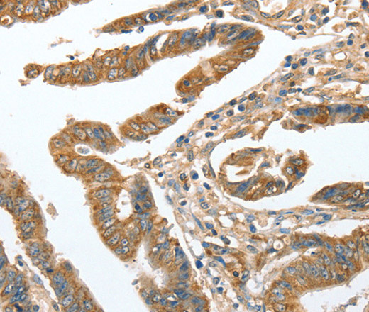 Immunohistochemistry of paraffin-embedded Human colon cancer tissue using CKAP2 Polyclonal Antibody at dilution 1:70