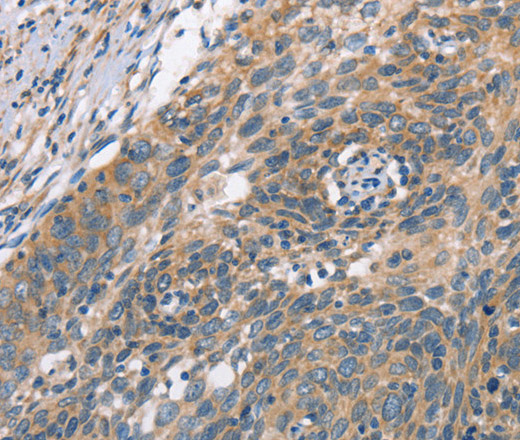 Immunohistochemistry of paraffin-embedded Human cervical cancer using PLEKHO1 Polyclonal Antibody at dilution of 1:70