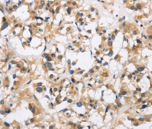 Immunohistochemistry of paraffin-embedded Human thyroid cancer using CKMT2 Polyclonal Antibody at dilution of 1:60