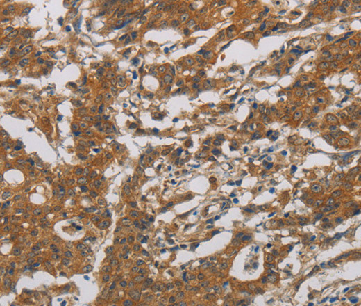 Immunohistochemistry of paraffin-embedded Human gastic cancer using CNDP1 Polyclonal Antibody at dilution of 1:30