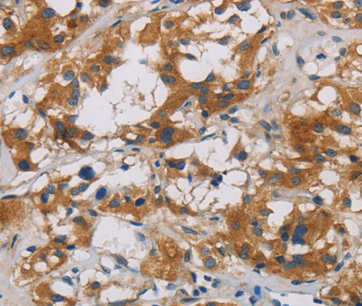 Immunohistochemistry of paraffin-embedded Human thyroid cancer using CNDP1 Polyclonal Antibody at dilution of 1:30